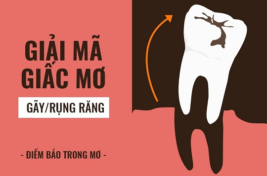 Giải mã giấc mơ bị gãy, rụng răng là tốt lành hay xui xẻo?